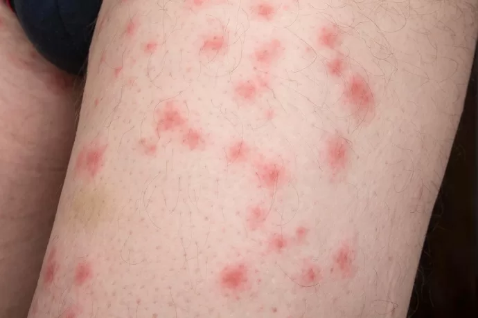 Bites on Your Skin