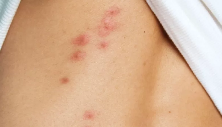 Unusual Rash or Allergic Reaction